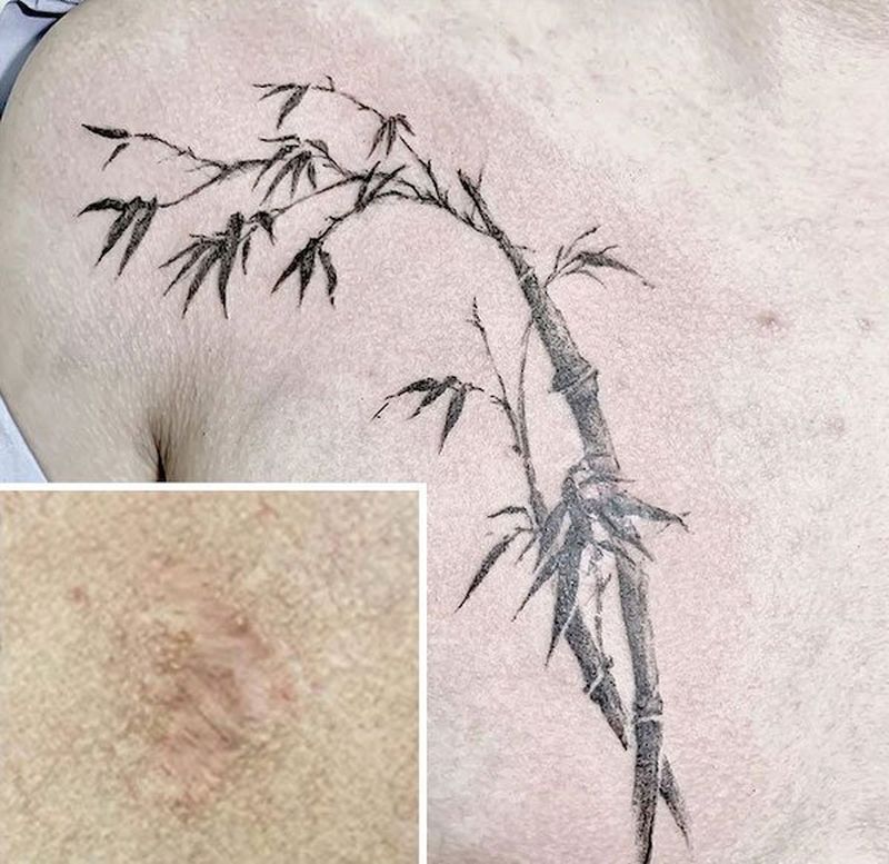 Ocultando cicatrices con tatuajes