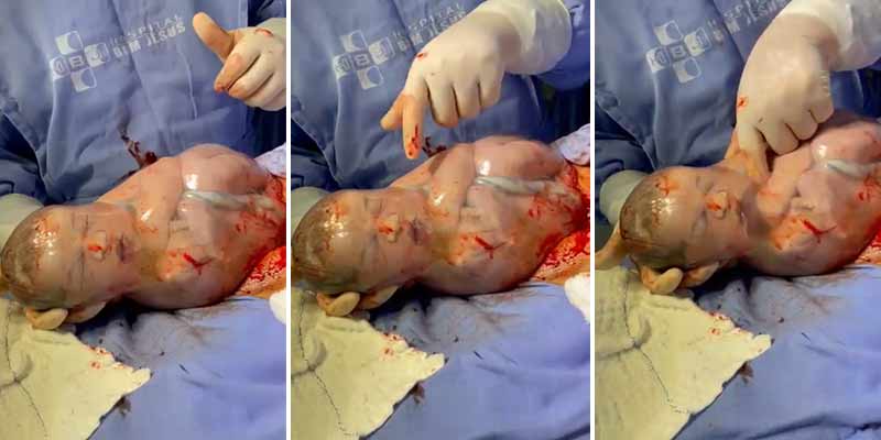 Impresionante: Bebés que nacen con el saco amniótico intacto