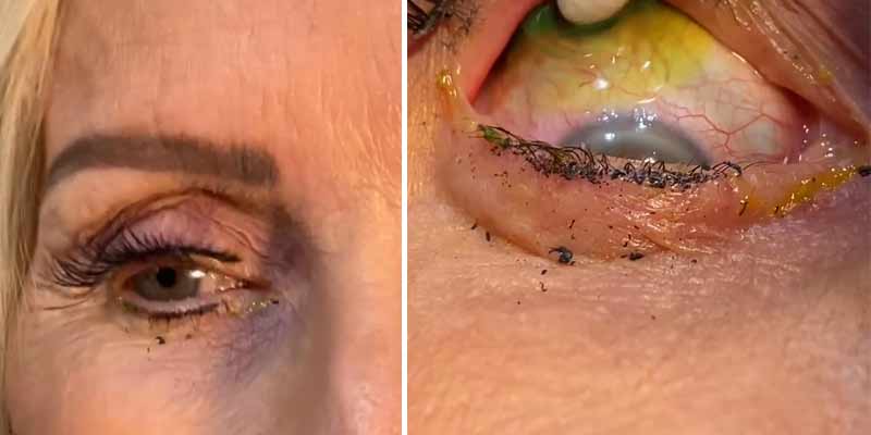 El oftalmólogo le retira del ojo a una mujer 23 letillas de contacto