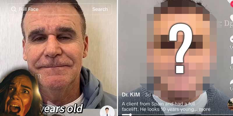 Un cirujano plástico publica en TikTok el antes y después de sus pacientes y es terrorífico