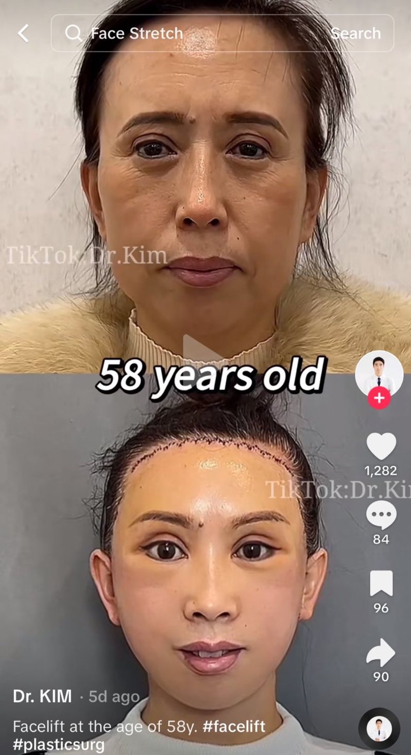 Un cirujano plástico publica en TikTok el antes y después de sus pacientes y es terrorífico